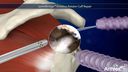 SpeedBridge™ Knotless Rotator Cuff Repair