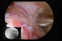 Acetabular Labral Repair
