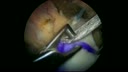Rotator Cuff Repair utilizing ArthroFlex® Augmentation